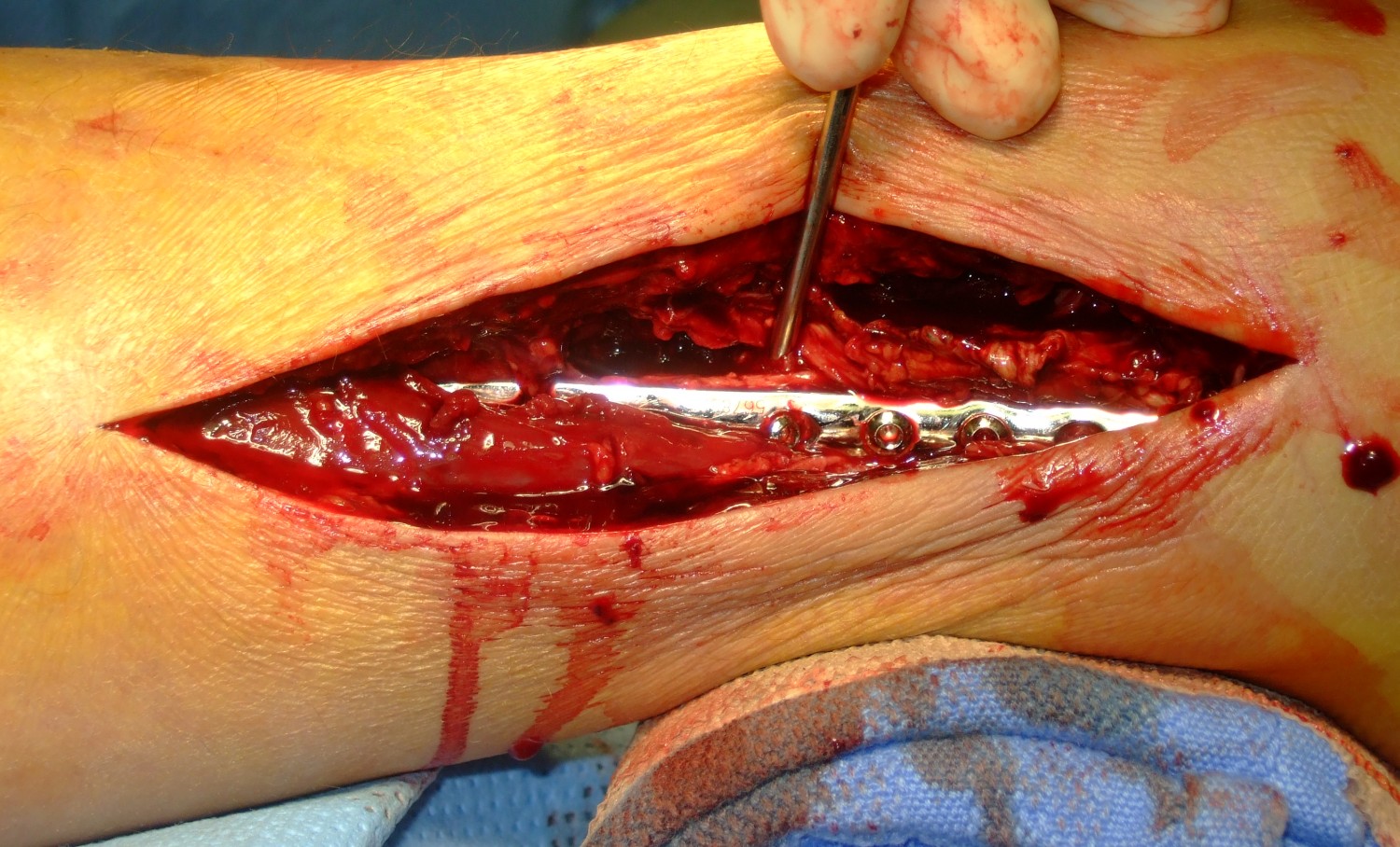 The large incision, showing the installed plate and screws in my right fibula