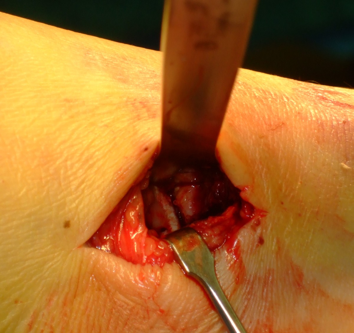 Close-up of the larger small incision on the inside of the leg