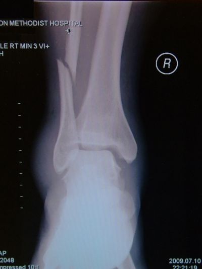 Inside of my newly broken leg