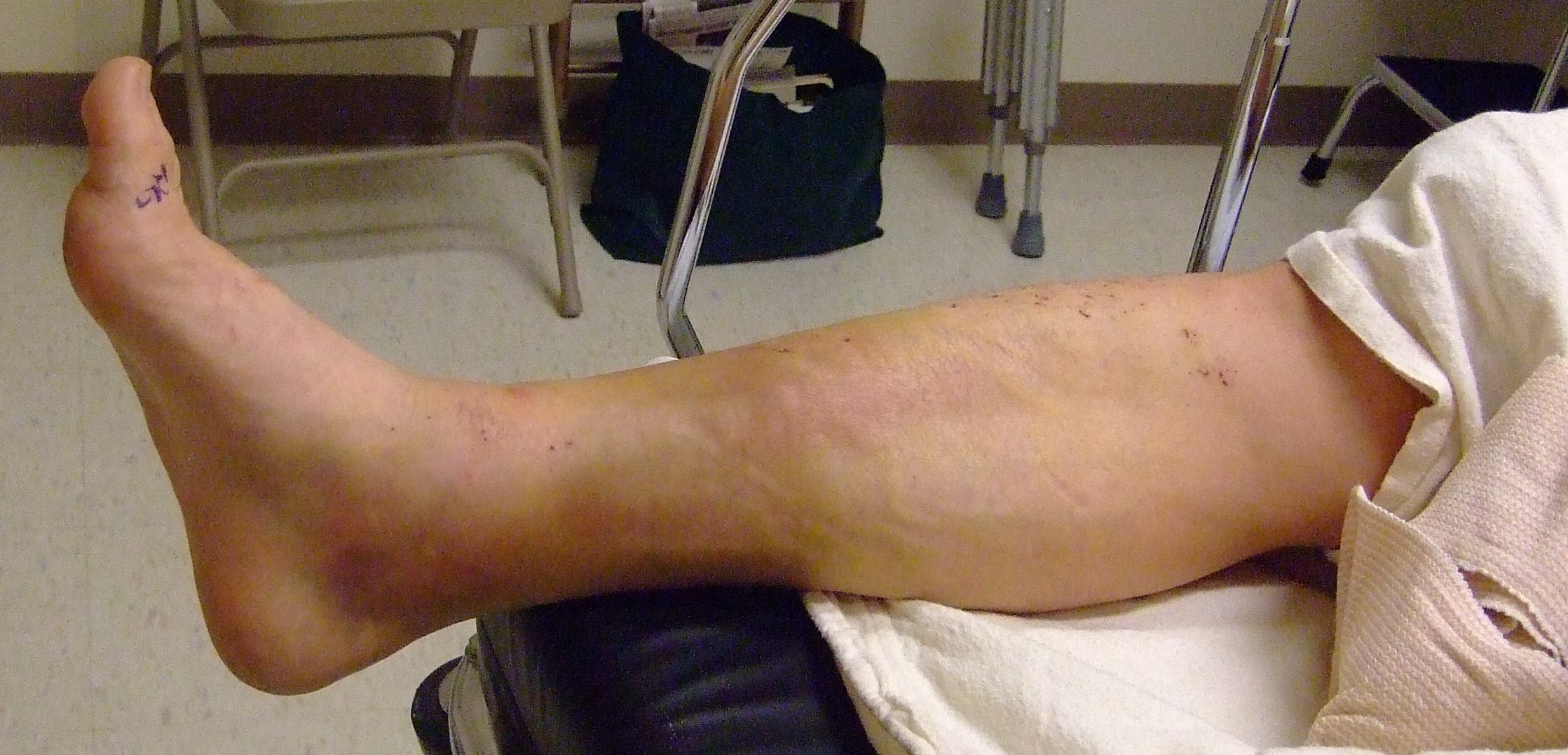 The leg before surgery