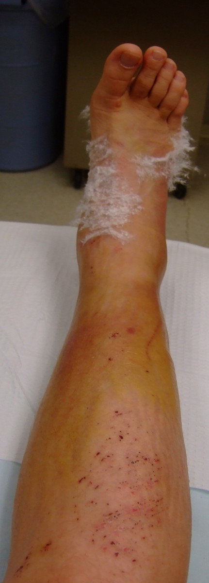 Discolored leg after 10 days
