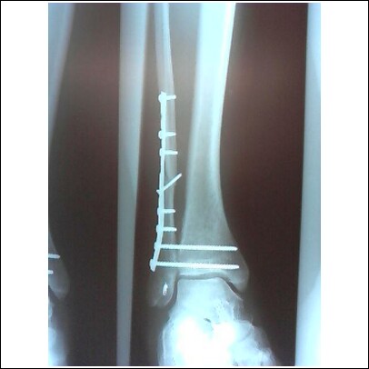 X-ray of the screws and plate, two weeks after surgery