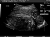 Sam in utero