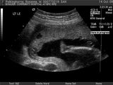 Sam in utero