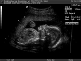 Sam in utero