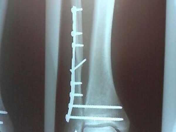 Leg full of hardware