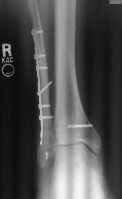 What my leg looks now, on the inside
